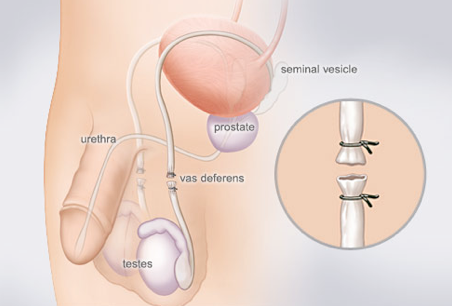 Vasectomy Procedure